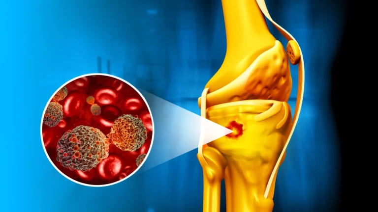 Nanoparticule magnetice: arma secreta împotriva cancerului osos